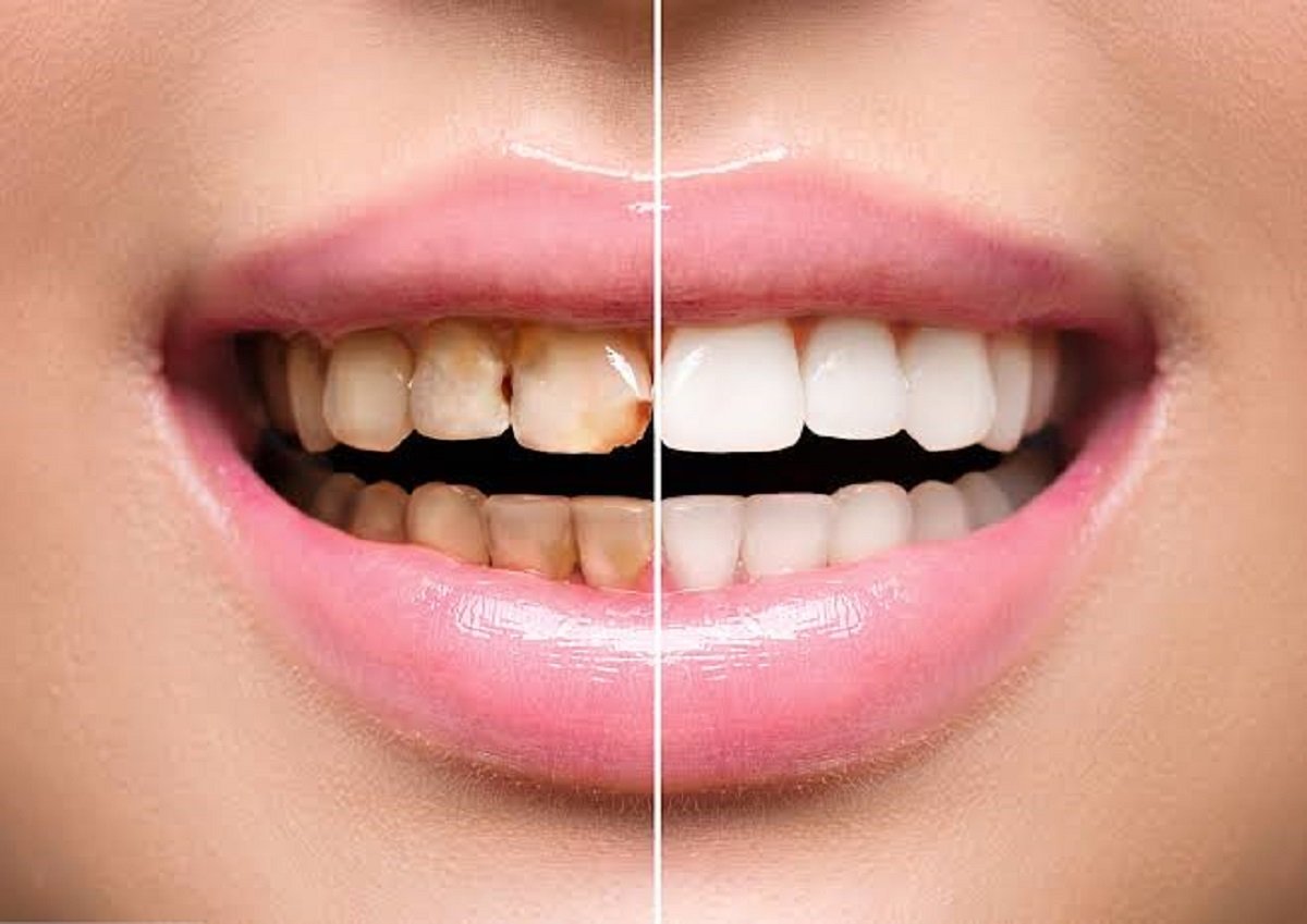 Dental resin restoring a cavity or enhancing your smile